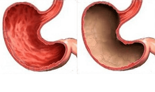 Ulcer, gastritis, cancer and other pathologies of the stomach (right), the appearance of which was caused by alcohol